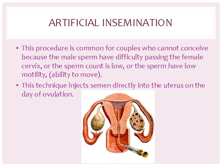 ARTIFICIAL INSEMINATION • This procedure is common for couples who cannot conceive because the