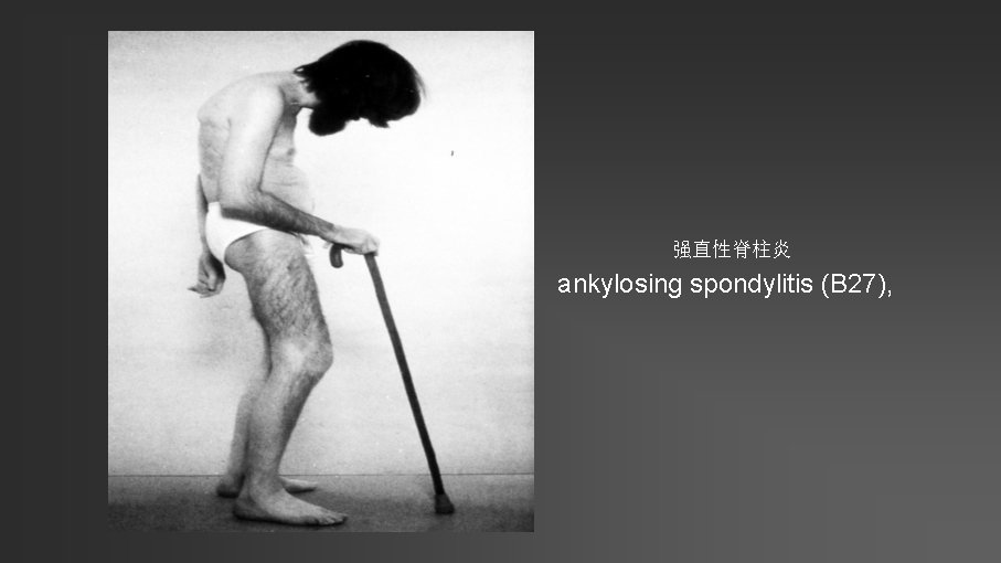 强直性脊柱炎 ankylosing spondylitis (B 27), 