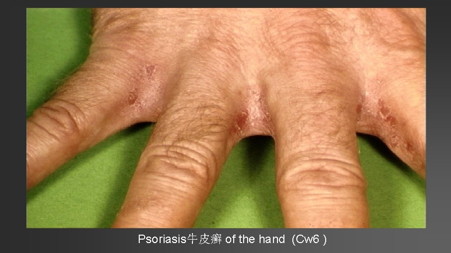 Psoriasis牛皮癣 of the hand (Cw 6 ) 