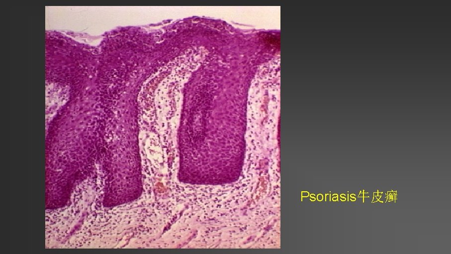 Psoriasis牛皮癣 