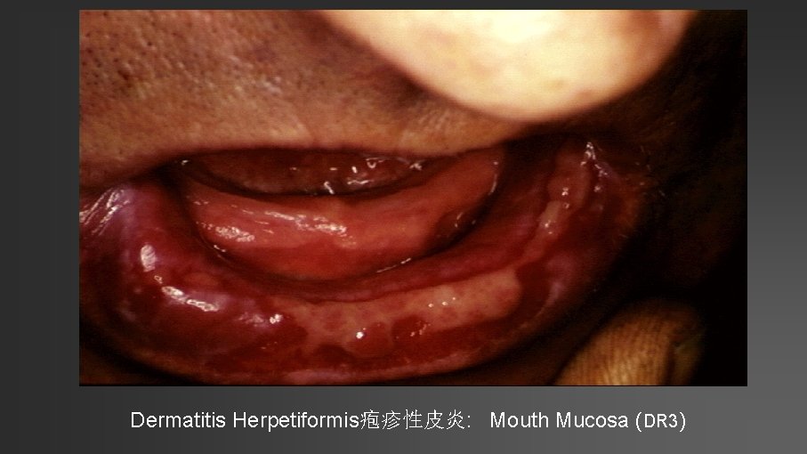 Dermatitis Herpetiformis疱疹性皮炎: Mouth Mucosa (DR 3) 