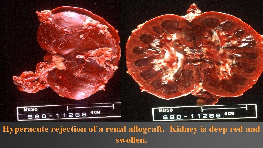 Hyperacute rejection of a renal allograft. Kidney is deep red and swollen. 