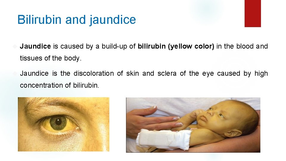 Bilirubin and jaundice Jaundice is caused by a build-up of bilirubin (yellow color) in