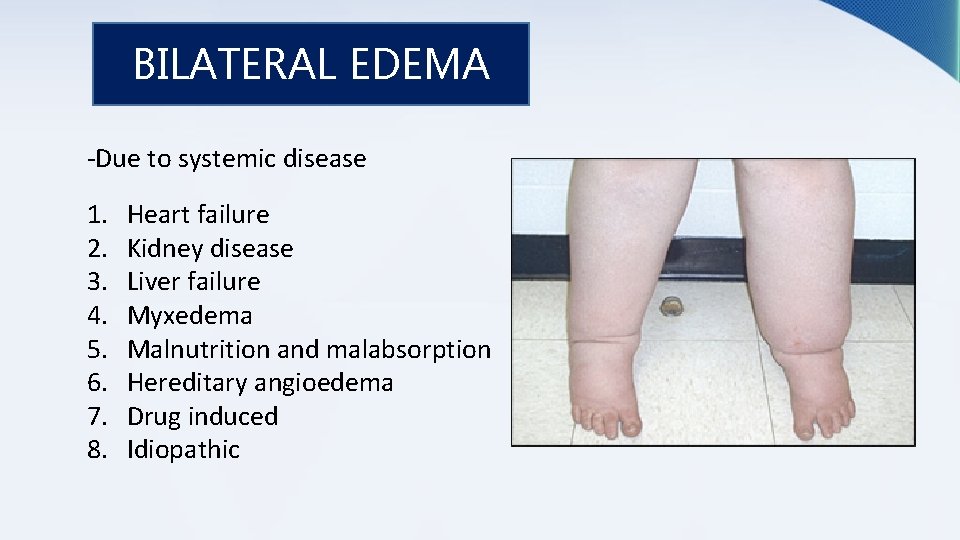 BILATERAL EDEMA -Due to systemic disease 1. 2. 3. 4. 5. 6. 7. 8.