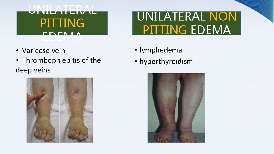 UNILATERAL PITTING EDEMA • Varicose vein • Thrombophlebitis of the deep veins UNILATERAL NON