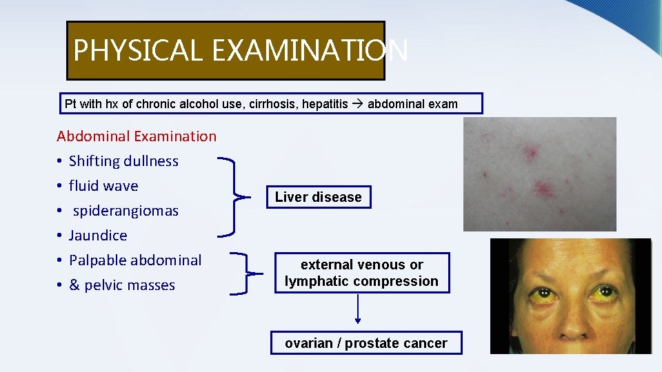PHYSICAL EXAMINATION Pt with hx of chronic alcohol use, cirrhosis, hepatitis abdominal exam Abdominal