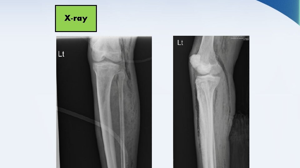 X-ray 