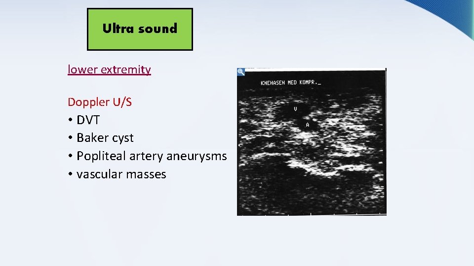 Ultra sound lower extremity Doppler U/S • DVT • Baker cyst • Popliteal artery