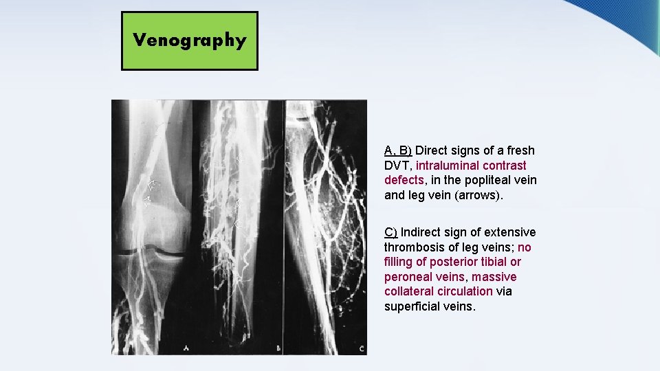 Venography A, B) Direct signs of a fresh DVT, intraluminal contrast defects, in the