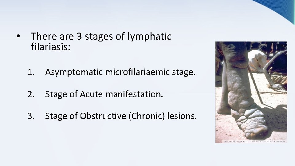  • There are 3 stages of lymphatic filariasis: 1. Asymptomatic microfilariaemic stage. 2.