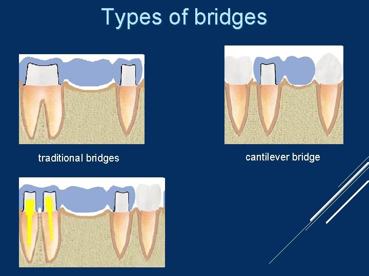 Types of bridges traditional bridges cantilever bridge 