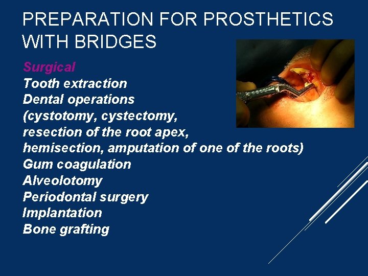 PREPARATION FOR PROSTHETICS WITH BRIDGES Surgical Tooth extraction Dental operations (cystotomy, cystectomy, resection of
