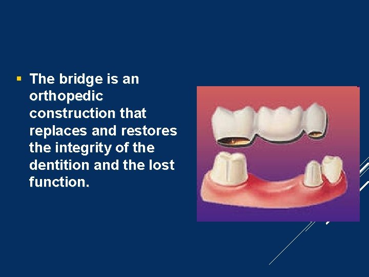  The bridge is an orthopedic construction that replaces and restores the integrity of
