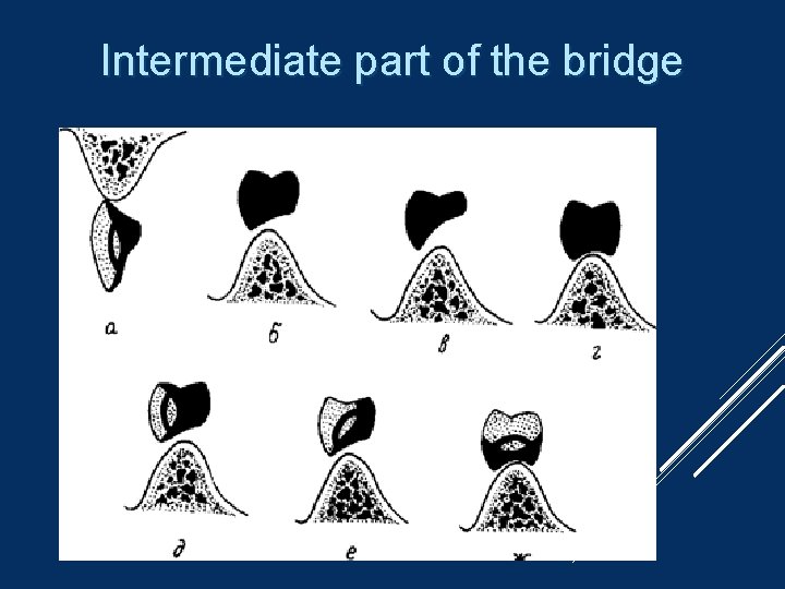 Intermediate part of the bridge 