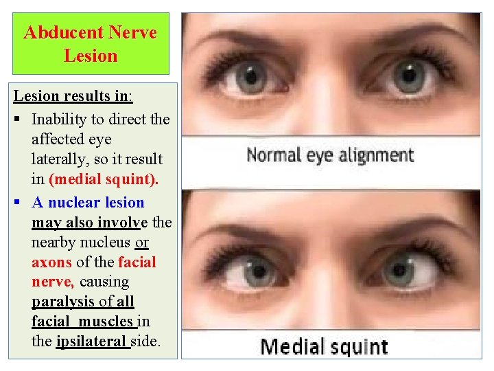 Abducent Nerve Lesion results in: § Inability to direct the affected eye laterally, so