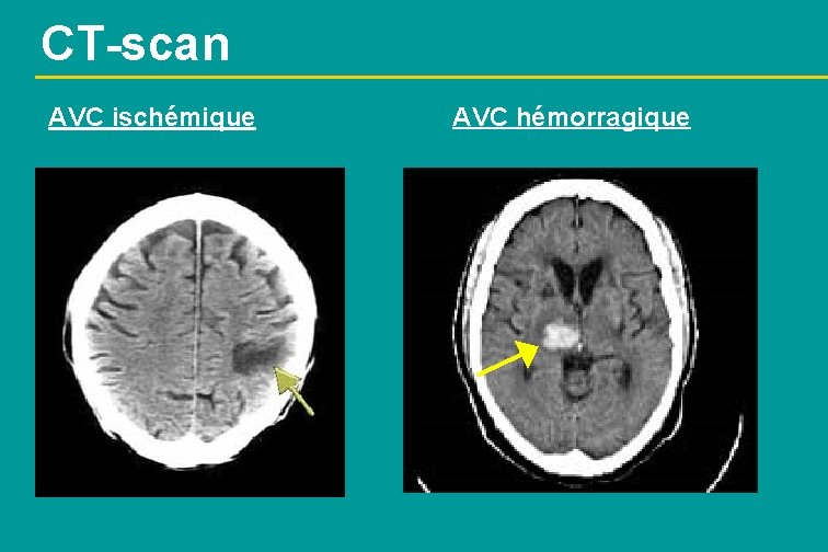 CT-scan AVC ischémique AVC hémorragique 