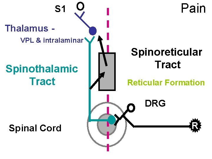 Pain S 1 Thalamus VPL & intralaminar Spinothalamic Tract Spinoreticular Tract Reticular Formation DRG