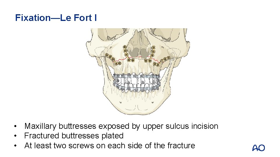 Fixation—Le Fort I • Maxillary buttresses exposed by upper sulcus incision • Fractured buttresses