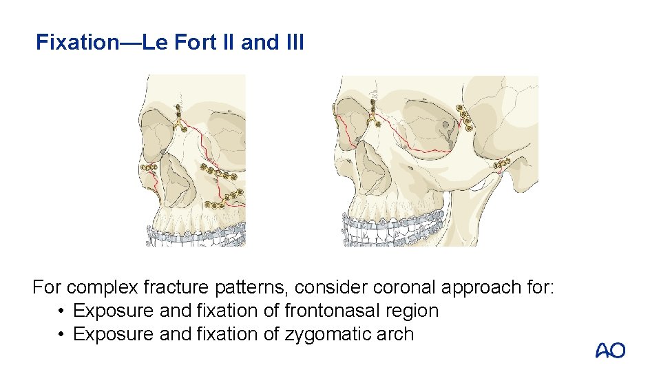 Fixation—Le Fort II and III For complex fracture patterns, consider coronal approach for: •