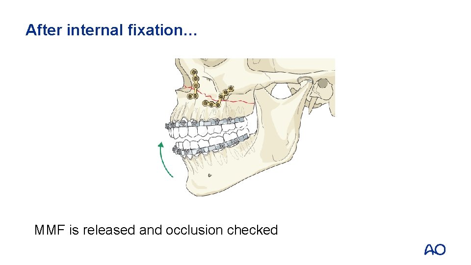 After internal fixation… MMF is released and occlusion checked 