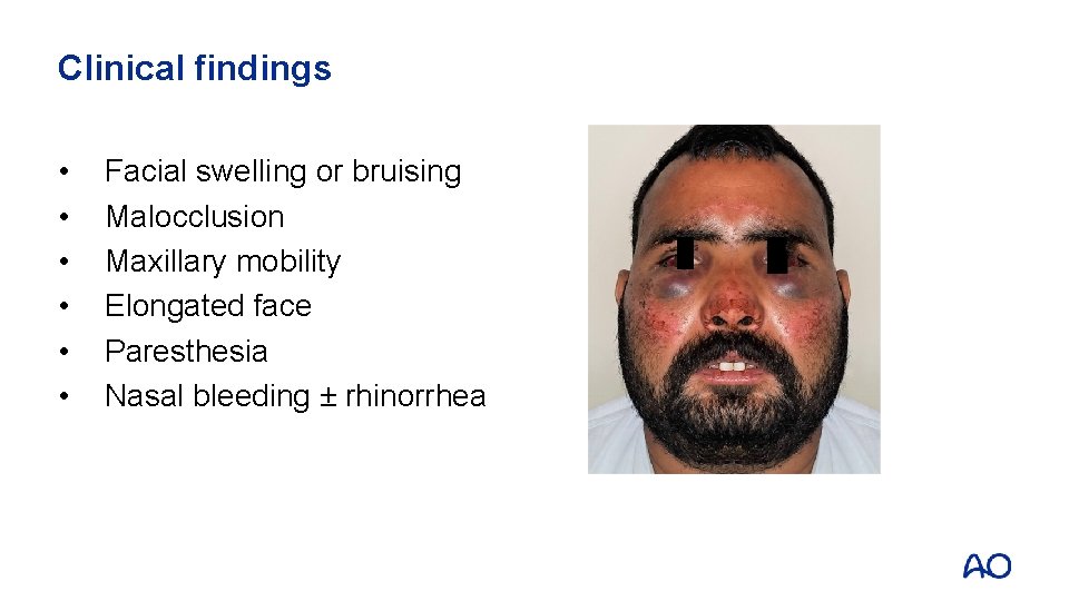 Clinical findings • • • Facial swelling or bruising Malocclusion Maxillary mobility Elongated face