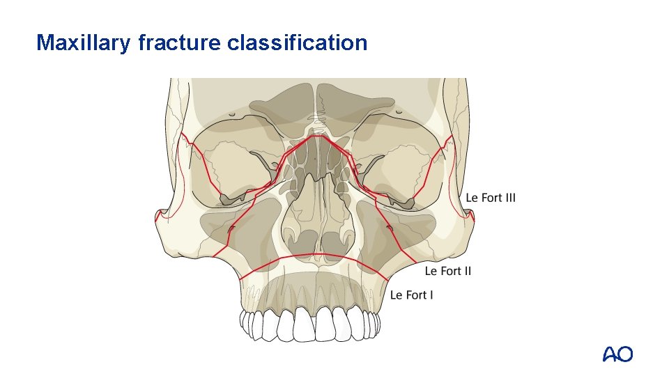 Maxillary fracture classification 