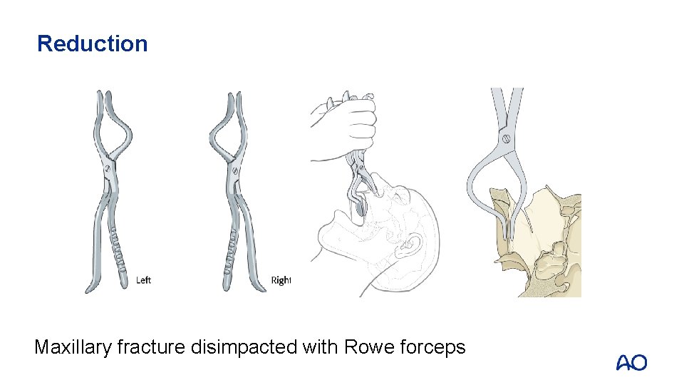 Reduction Maxillary fracture disimpacted with Rowe forceps 