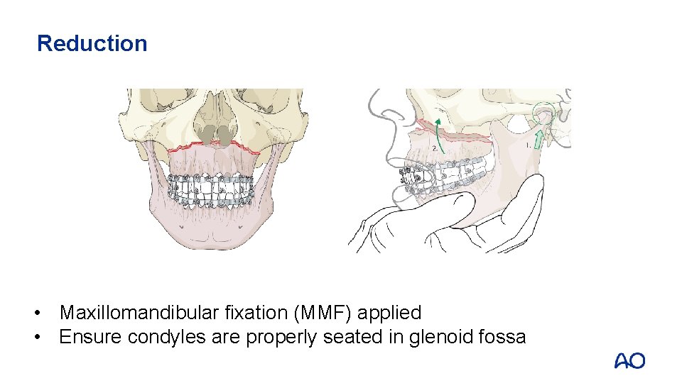 Reduction • Maxillomandibular fixation (MMF) applied • Ensure condyles are properly seated in glenoid