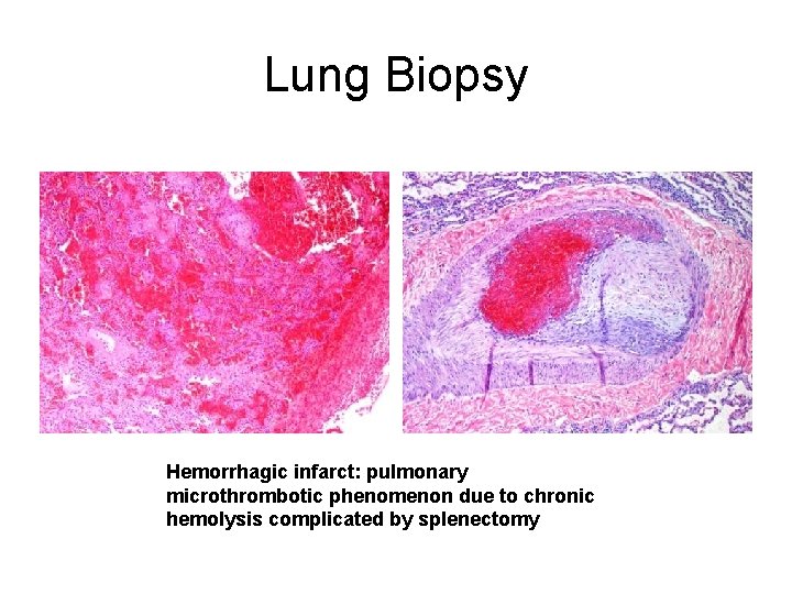 Lung Biopsy Hemorrhagic infarct: pulmonary microthrombotic phenomenon due to chronic hemolysis complicated by splenectomy