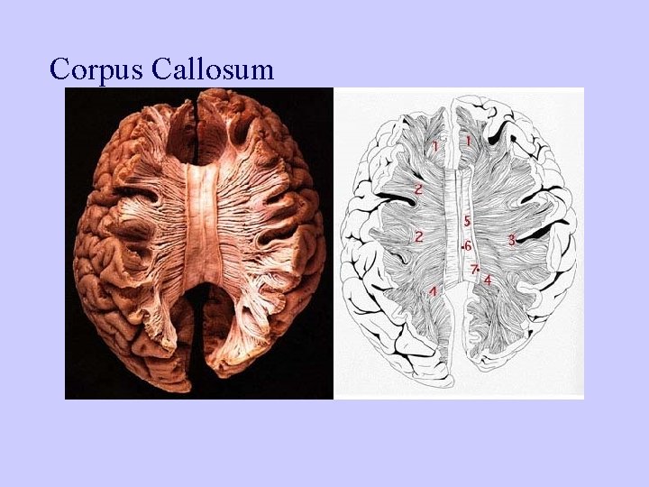 Corpus Callosum 