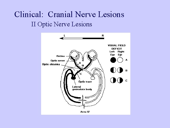 Clinical: Cranial Nerve Lesions II Optic Nerve Lesions 