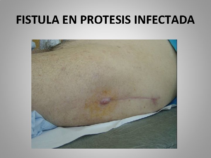 FISTULA EN PROTESIS INFECTADA 