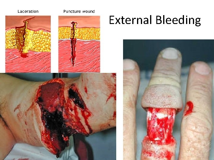External Bleeding 