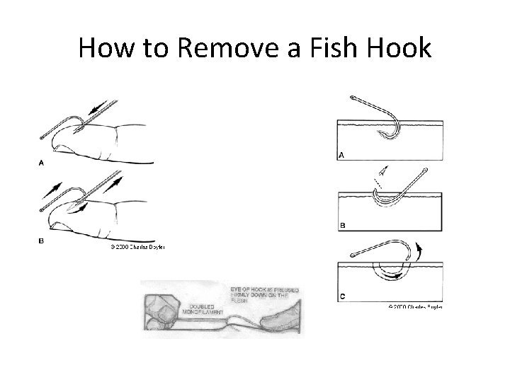 How to Remove a Fish Hook 