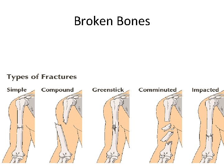 Broken Bones 