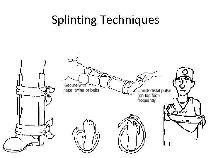 Splinting Techniques 