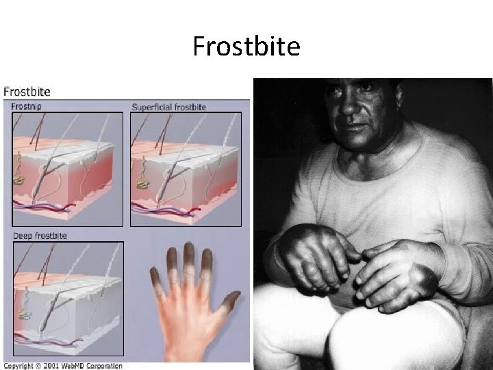Frostbite 