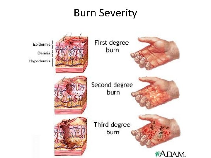 Burn Severity 