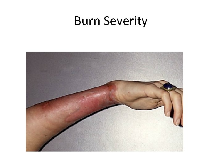 Burn Severity 