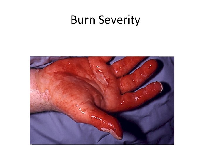 Burn Severity 