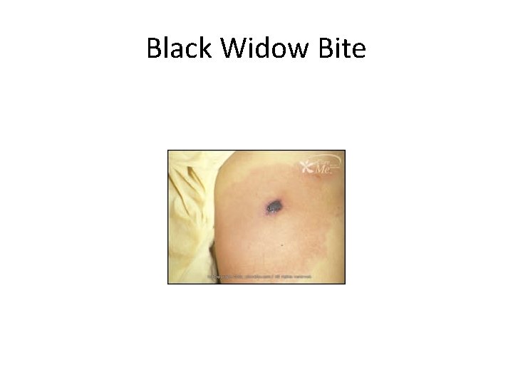 Black Widow Bite 