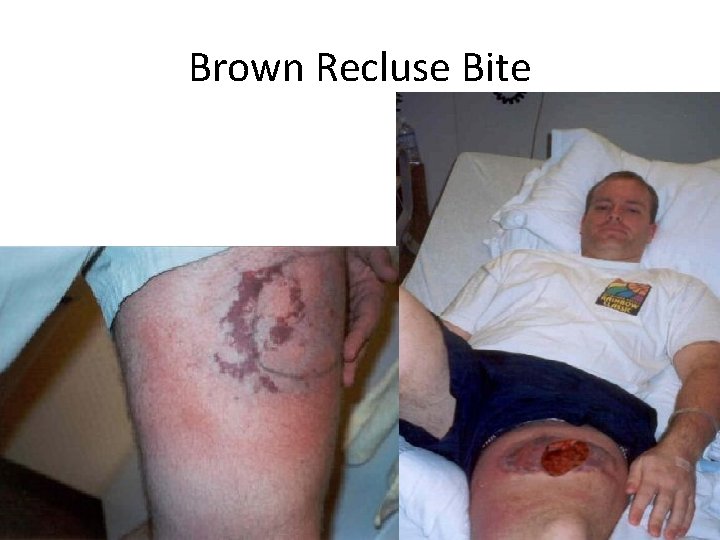 Brown Recluse Bite 