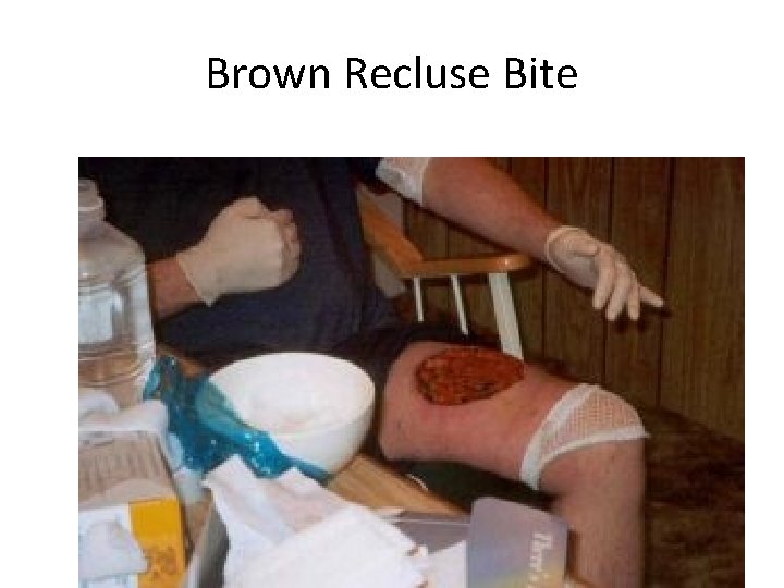 Brown Recluse Bite 