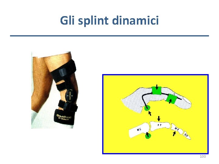 Gli splint dinamici 100 