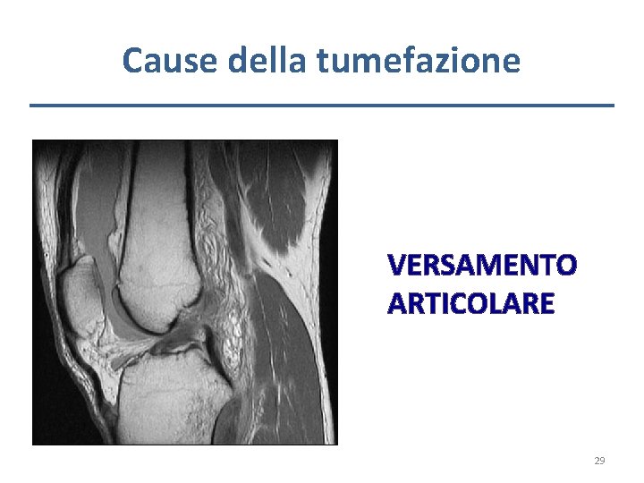 Cause della tumefazione VERSAMENTO ARTICOLARE 29 