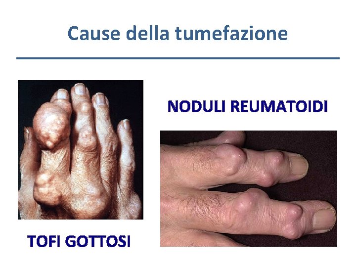 Cause della tumefazione NODULI REUMATOIDI TOFI GOTTOSI 