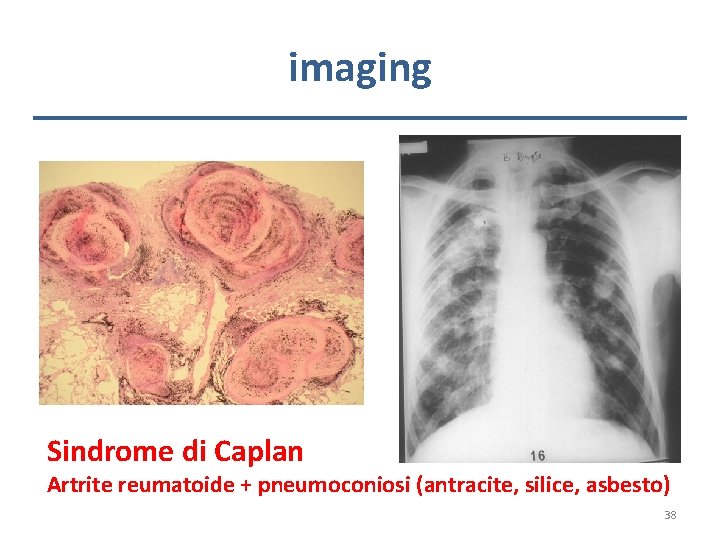 imaging Sindrome di Caplan Artrite reumatoide + pneumoconiosi (antracite, silice, asbesto) 38 