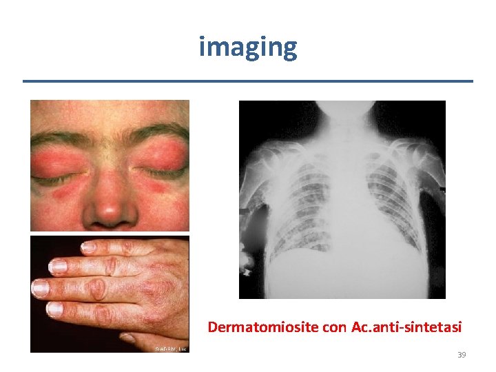 imaging Dermatomiosite con Ac. anti-sintetasi 39 