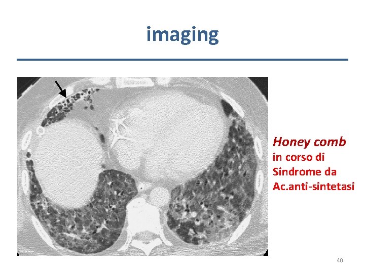 imaging Honey comb in corso di Sindrome da Ac. anti-sintetasi 40 