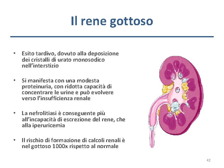 Il rene gottoso • Esito tardivo, dovuto alla deposizione dei cristalli di urato monosodico